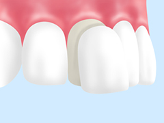 ラミネートベニア　つけ爪のように前歯に被せて装着