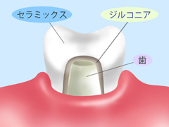 ジルコニアクラウン　強さだけでなく美しさも一級品