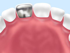 硬質レジン前装冠　保険診療適用で安価なのが特徴
