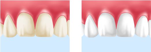 3.	ウォーキングブリーチ　神経を失った歯の黒ずみを白く