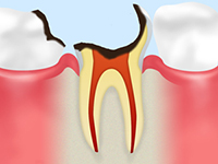 C4（重度の虫歯）