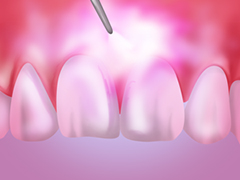 虫歯治療にはレーザーを使用