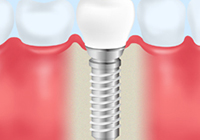インプラント