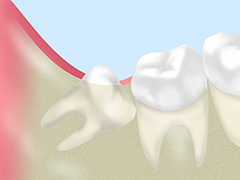 親知らずの抜歯